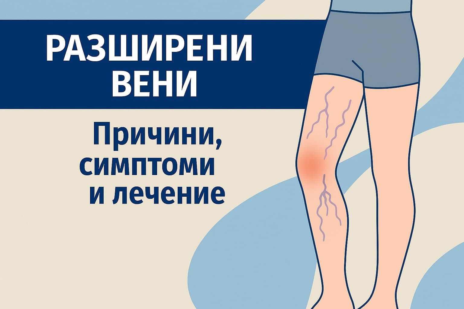 Разширени вени - причини, симптоми и лечение